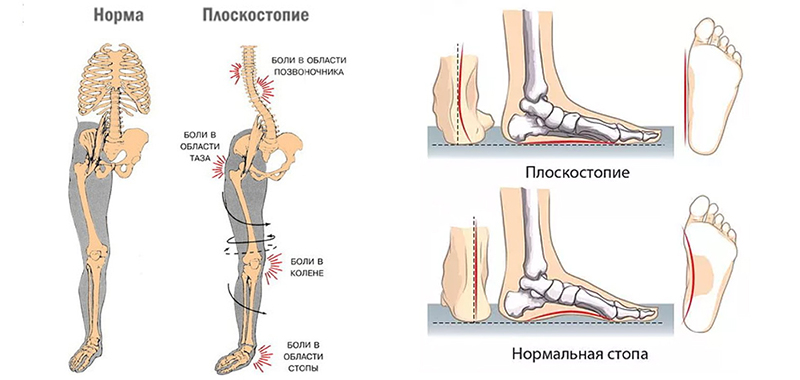 ортопедические стельки