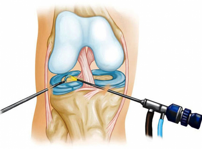 Артроскопия коленного сустава: показания к применению и преимущества