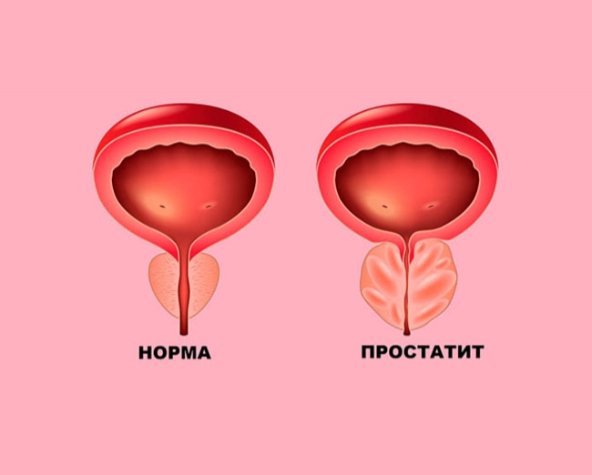 Лечение воспаления предстательной железы: симптомы, причины развития, ультразвуковое исследование простаты