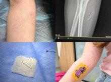 Тиждень з голкою в руці: на Львівщині 13-річній школярці провели операцію