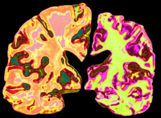 Вчені з Гарварду виявили можливий спосіб відновлення пам’яті при хворобі Альцгеймера