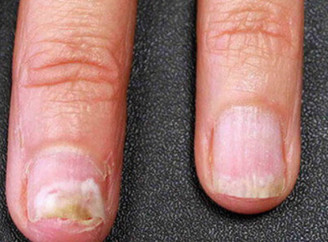 Грибок нігтів: коли естетична проблема стає медичною