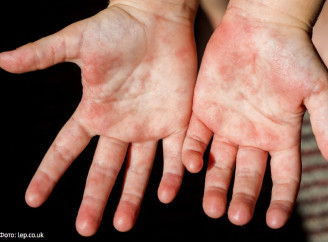 На Чернігівщині зафіксували летальний випадок скарлатини - подробиці