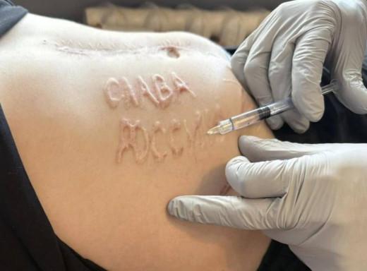 Лікарі розпочали видалення напису «слава росії» з тіла українського військового фото