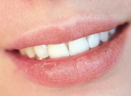 Чому тріскаються губи і як цього позбутися: корисні б’юті-поради фото