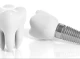 Имплантация зубов: возвращаем улыбку и уверенность